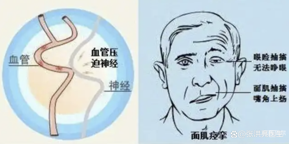 国产痉挛免费在线观看面肌痉挛，国产创新疗法引领医疗新篇章